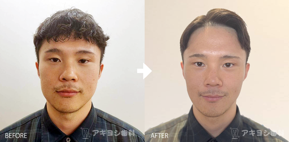 ボトックス症例