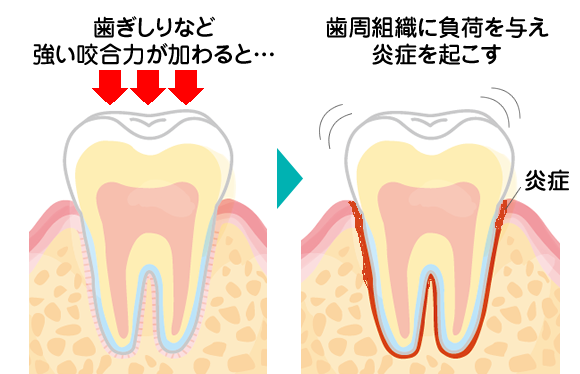 咬合による炎症