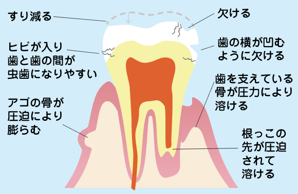 噛みしめの力が強すぎることで起こる悪影響
