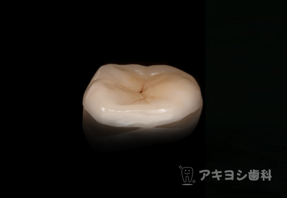 セラミックアンレー