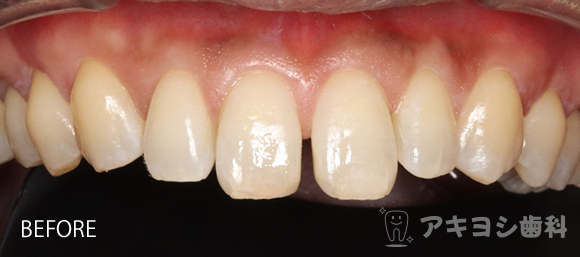 術前：すきっ歯のダイレクトボンディング