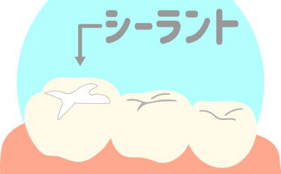 シーラント