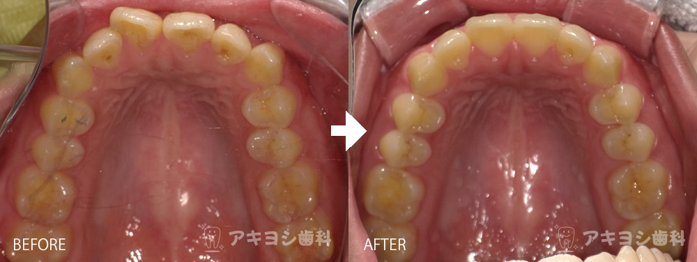上顎:マウスピース矯正症例