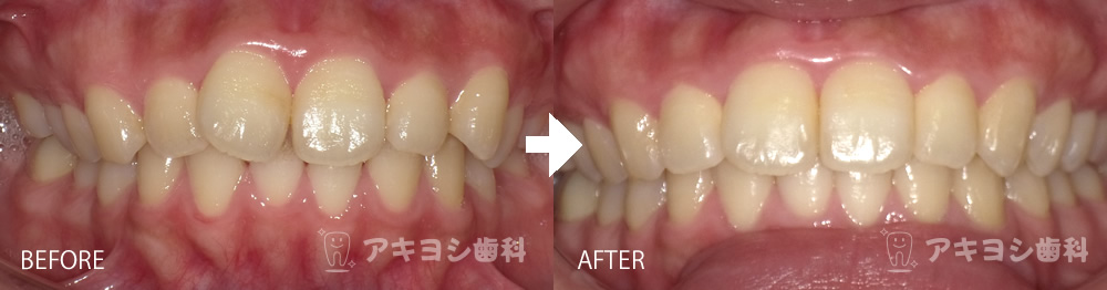 正面:マウスピース矯正症例