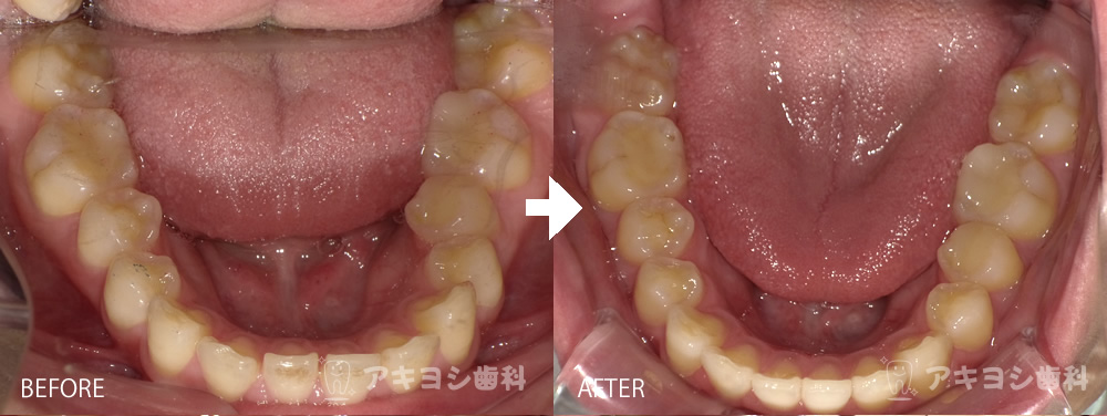 下顎:マウスピース矯正症例