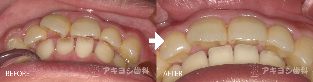 上顎前歯:マウスピース矯正症例