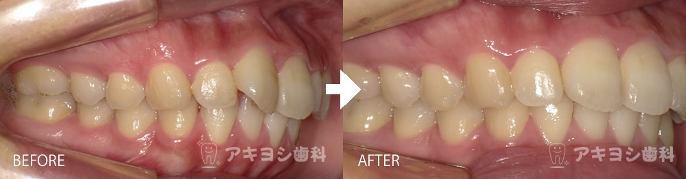 右側:マウスピース矯正症例