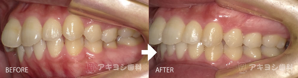 左側:マウスピース矯正症例