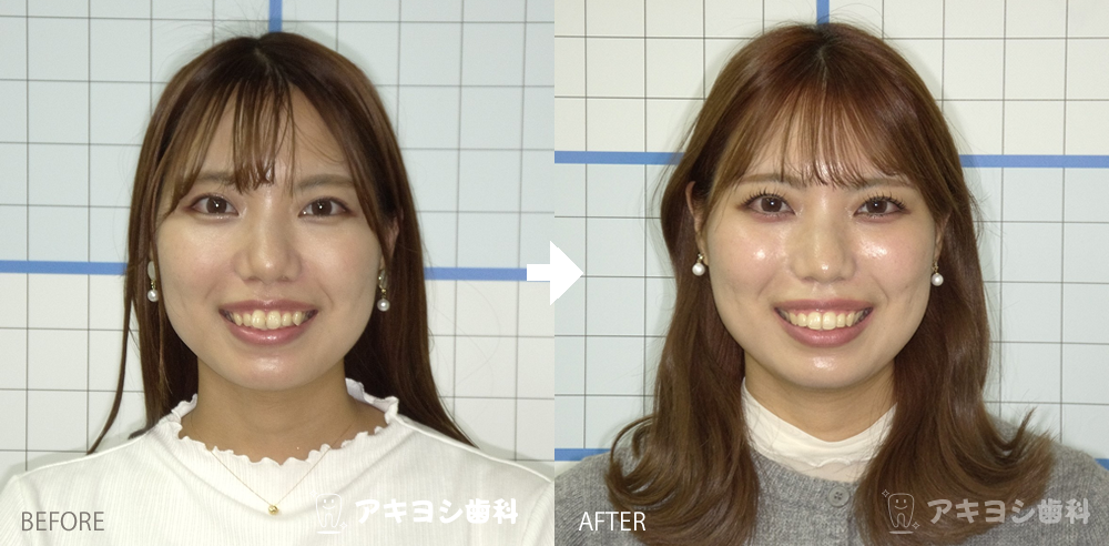顔貌:マウスピース矯正症例