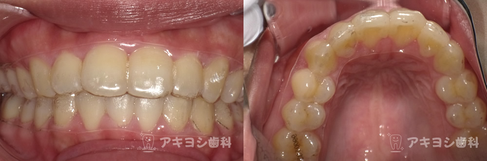 マウスピース矯正装置装着の様子