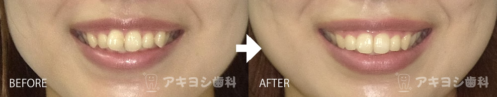 口元:マウスピース矯正症例