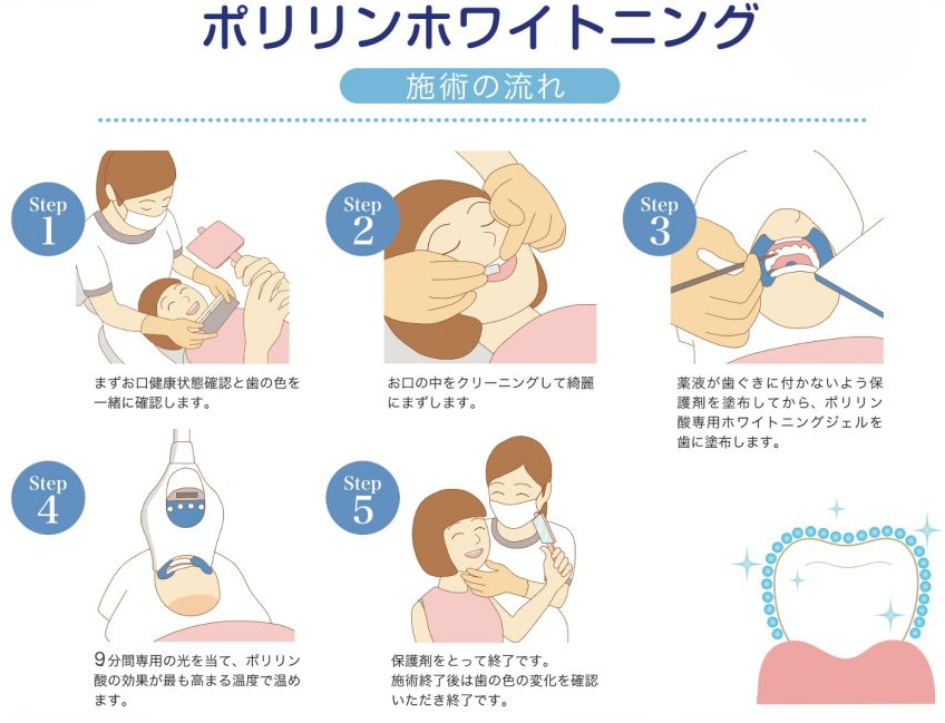 オフィスホワイトニング流れ