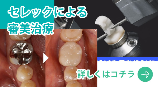 セレック
